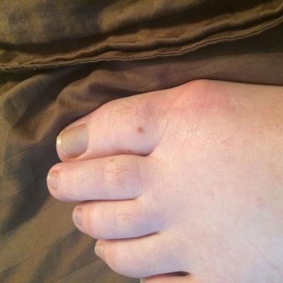 inflamed bursal sac?