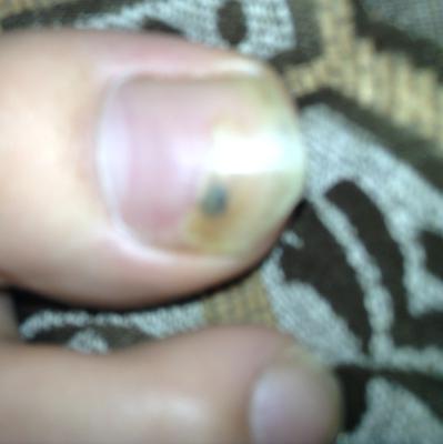 Under toenail spot black What does