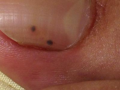 Black Spot Under Toenail