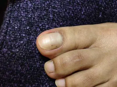 On dot small toenail black Black Spots