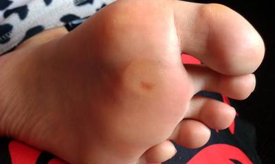 blood spot under foot