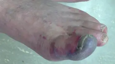 blue toe syndrome