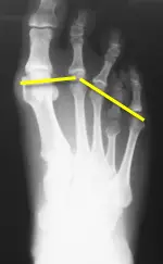 brachymetatarsia xray