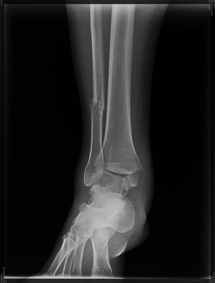 Broken fibula and ankle bone