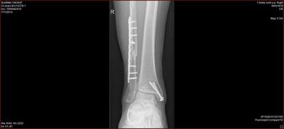 Broken fibula and ankle bone-part 2