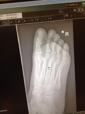 metatarsal fractures