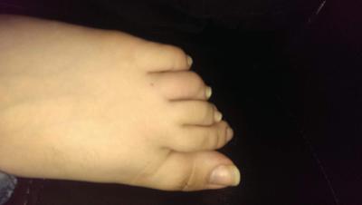 day 1 broken toe?