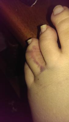 day 3 broken toe?