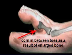 soft corn on second toe