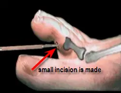 incision of skin for soft corn