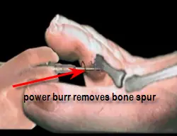 section of bone to be removed in soft corn