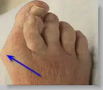 bunion deformity