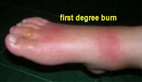 first_degree_burn