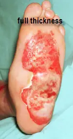 third_degree_burn