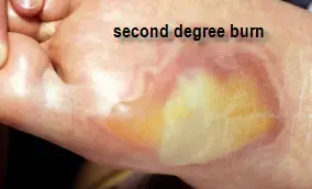 second_degree_burn
