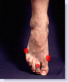 bursitis on top of foot