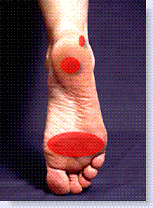 bursitis on bottom of foot