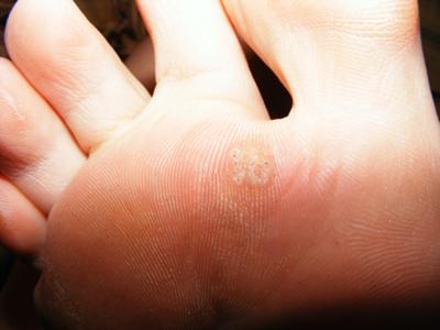 plantar callus