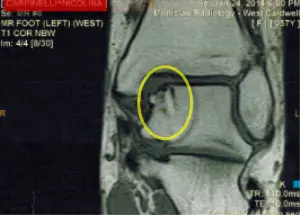 osteochondritis dessicans of talus