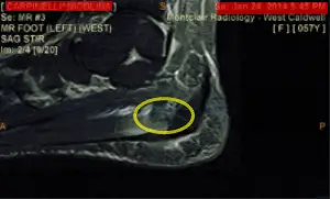 plantarfascial tear on mri