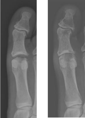 MTP Cartiva 1 mos & 3 mos Post-Op