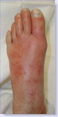 foot infection