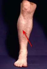 compartment_syndrome
