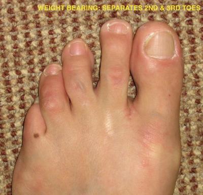 spreading of toes from Mortons neuroma