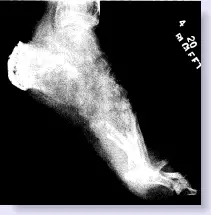 crps xray