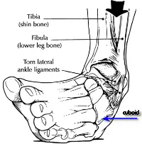 cuboid syndrome drawing