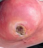 decubitus_ulcer