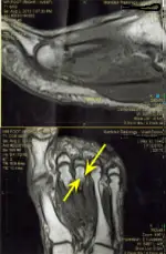 metatarsal stress fracture