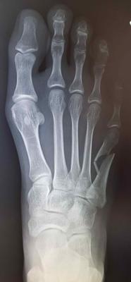 initial displaced fifth metatarsal fracture