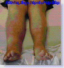 deep vein thrombosis or DVT