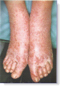 neurodermatitis of foot