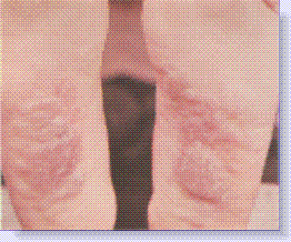 eczema on bottom of foot
