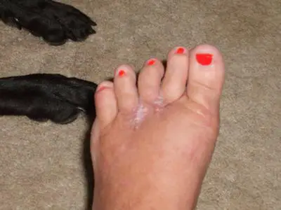 5 months post op for Mortons neuroma