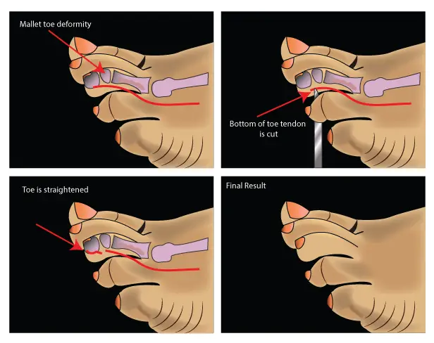 mallet toe surgery