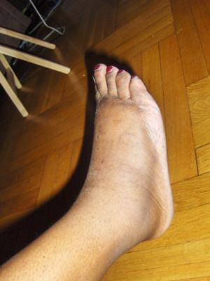 swollen right foot.