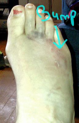 Foot trauma from dropped weight