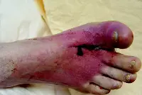 puncture wound in foot