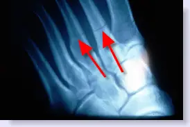 stress fracture of foot 
