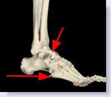 poorly vascularized fractures of the foot 