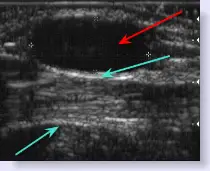 ultrasound of ganglion cyst