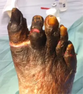 gangrene of the toes