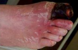 foot_gangrene