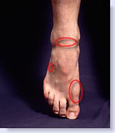 gout in big toe