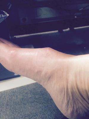 lump after ganglion cyst removal on foot