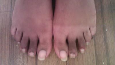 Both feet are different from hammertoe surgery