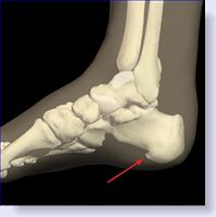 heel spur